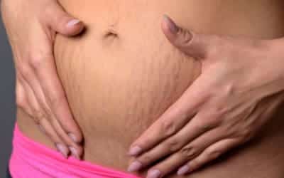 Stretch marks in pregnancy