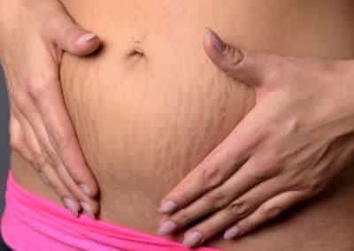 Stretch marks in pregnancy