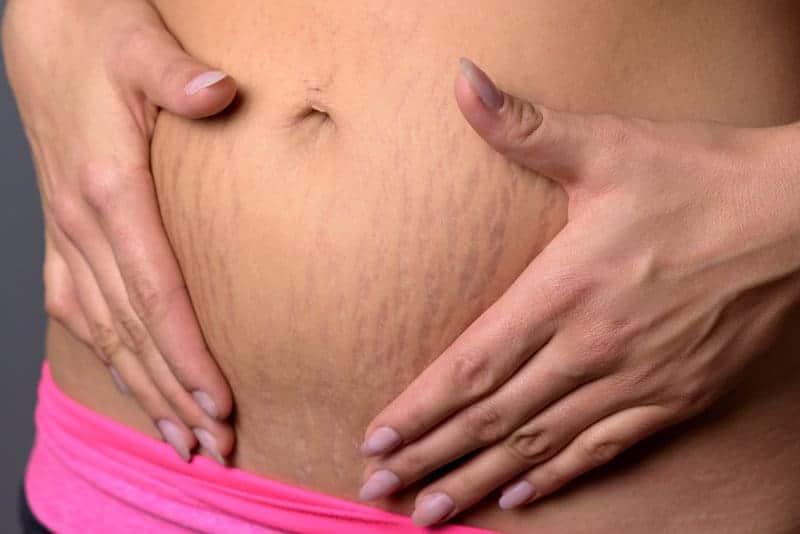 Stretch marks in pregnancy