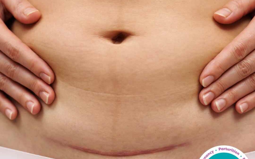 Factsheet: Caesarean Section Recovery