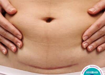 Factsheet: Caesarean Section Recovery