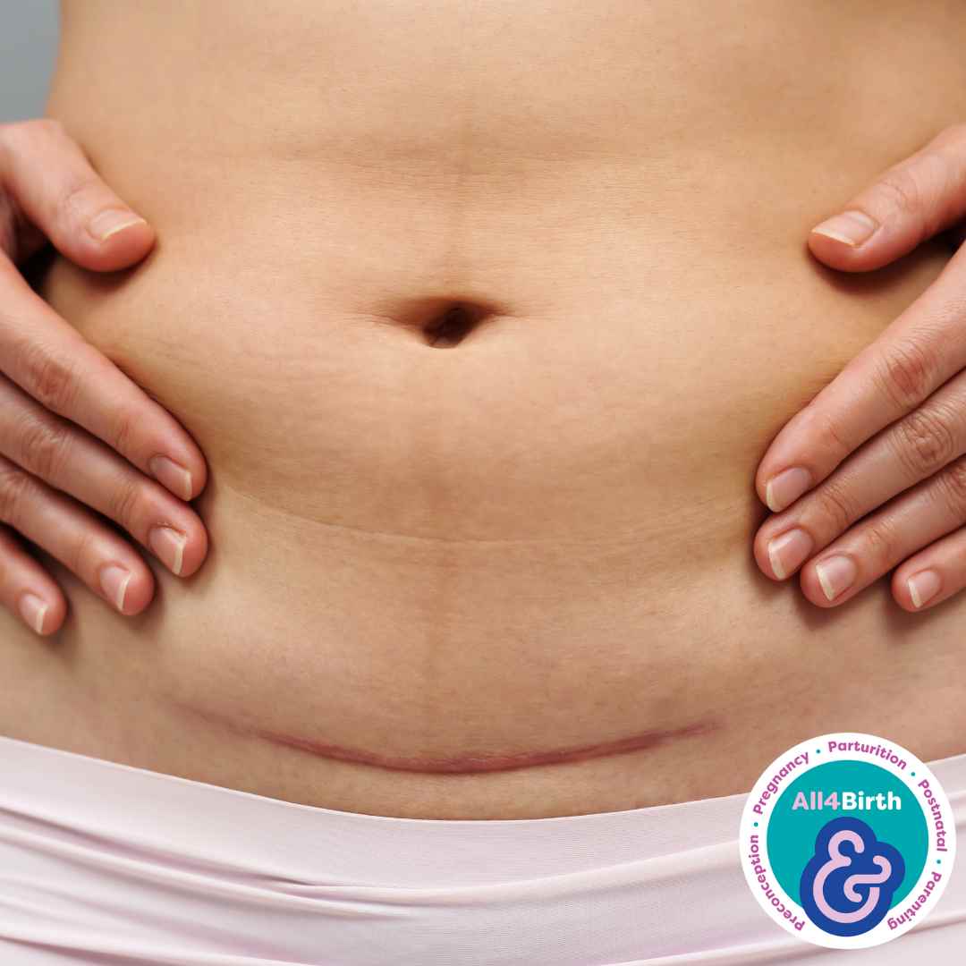 Factsheet: Caesarean Section Recovery