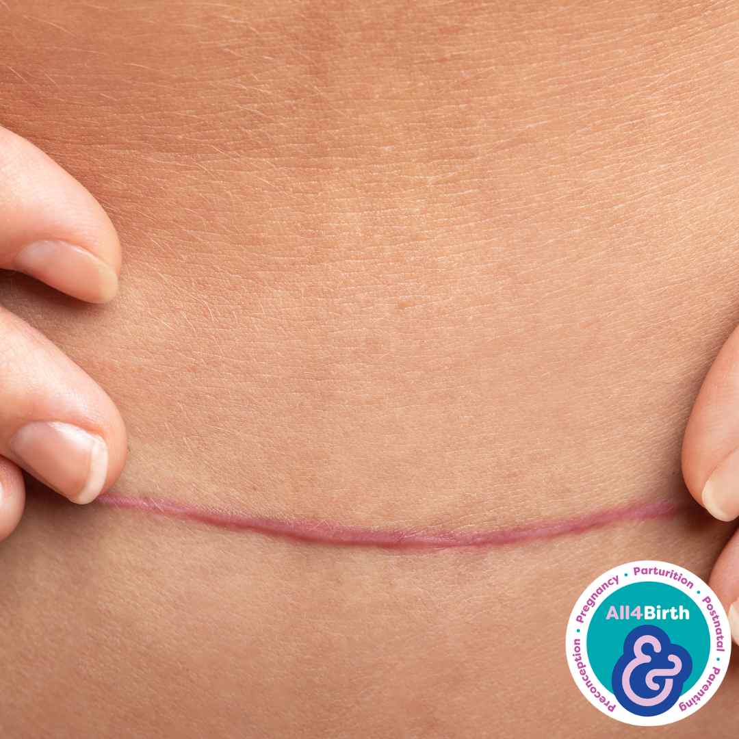 Factsheet: Vaginal Birth After Caesarean: options, success rates, what improves success, and why it matters